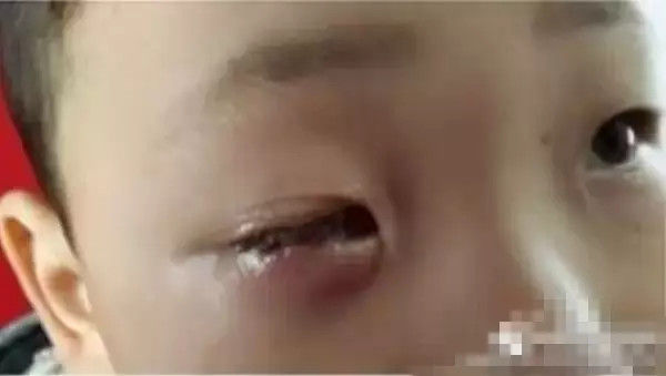 八岁男童玩干燥剂 一只眼睛被炸瞎