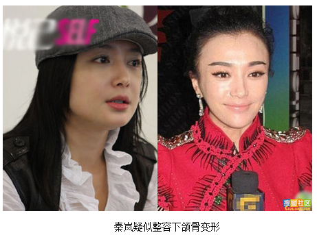 秦岚整容前后对比照 网友:又一个明星整容失败