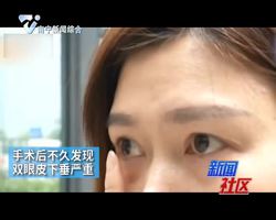 【社区故事】杭州：女子割双眼皮后下垂 美容院：地球引力