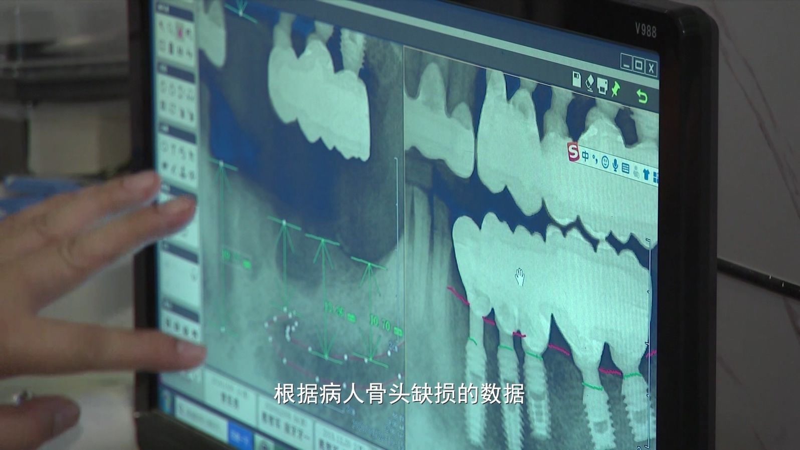 2021年南宁市第六届创业大赛二等奖（社会组）：干细胞3D骨再生技术