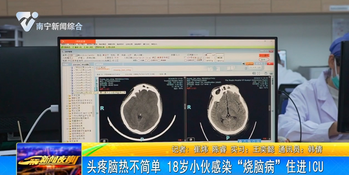 头疼脑热不简单 18岁小伙感染“烧脑病”住进ICU 