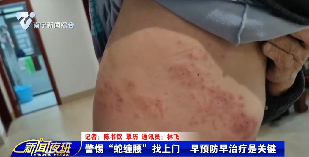 警惕“蛇缠腰”找上门 早预防早治疗是关键